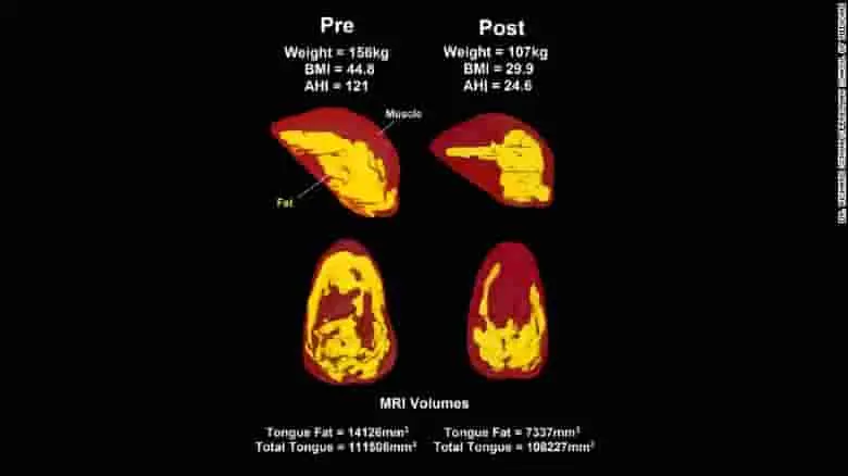 lengua con grasa antes y despues del tratamiento de descenso de peso en RMN
