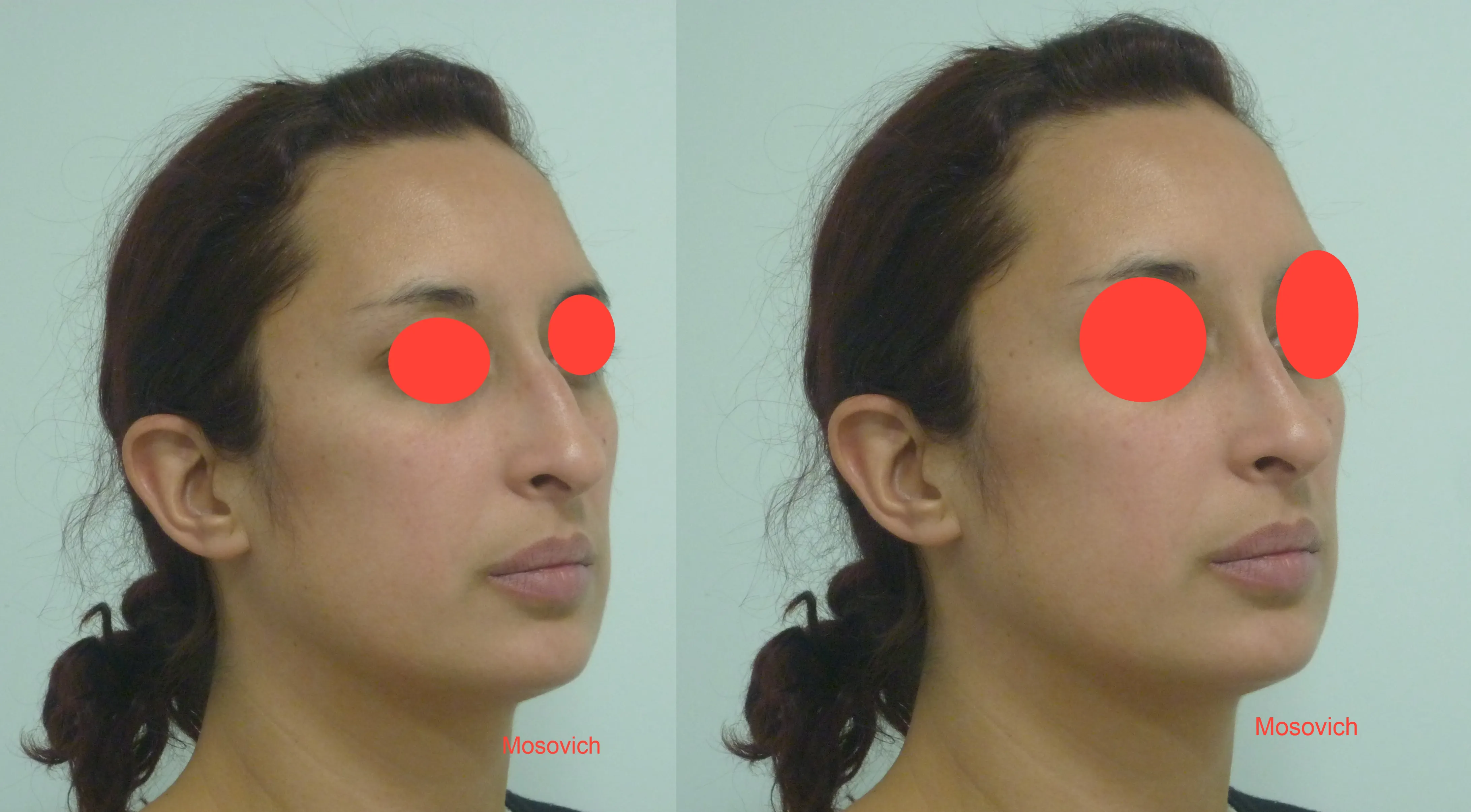 imagen rinoplastia