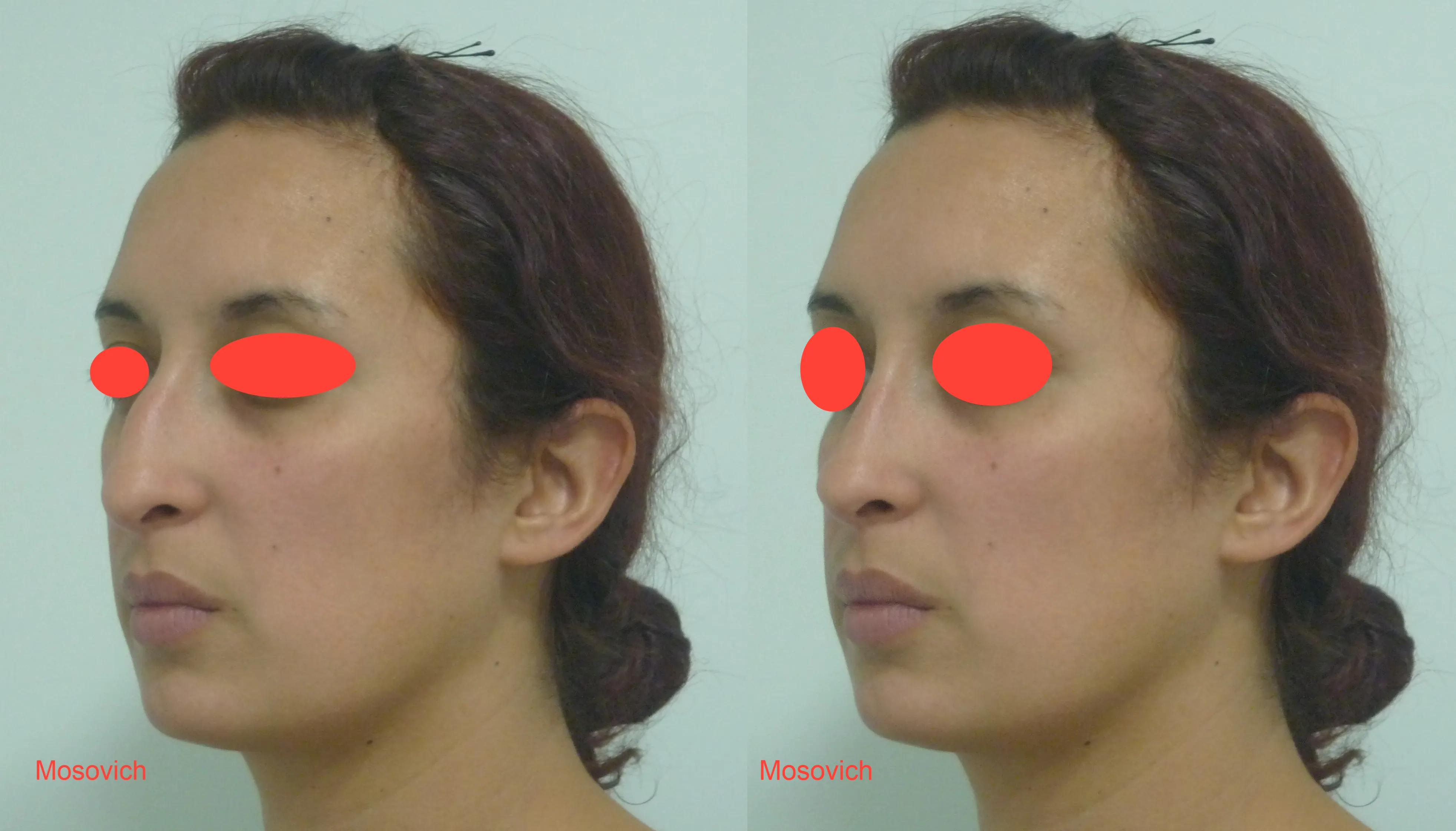 imagen rinoplastia