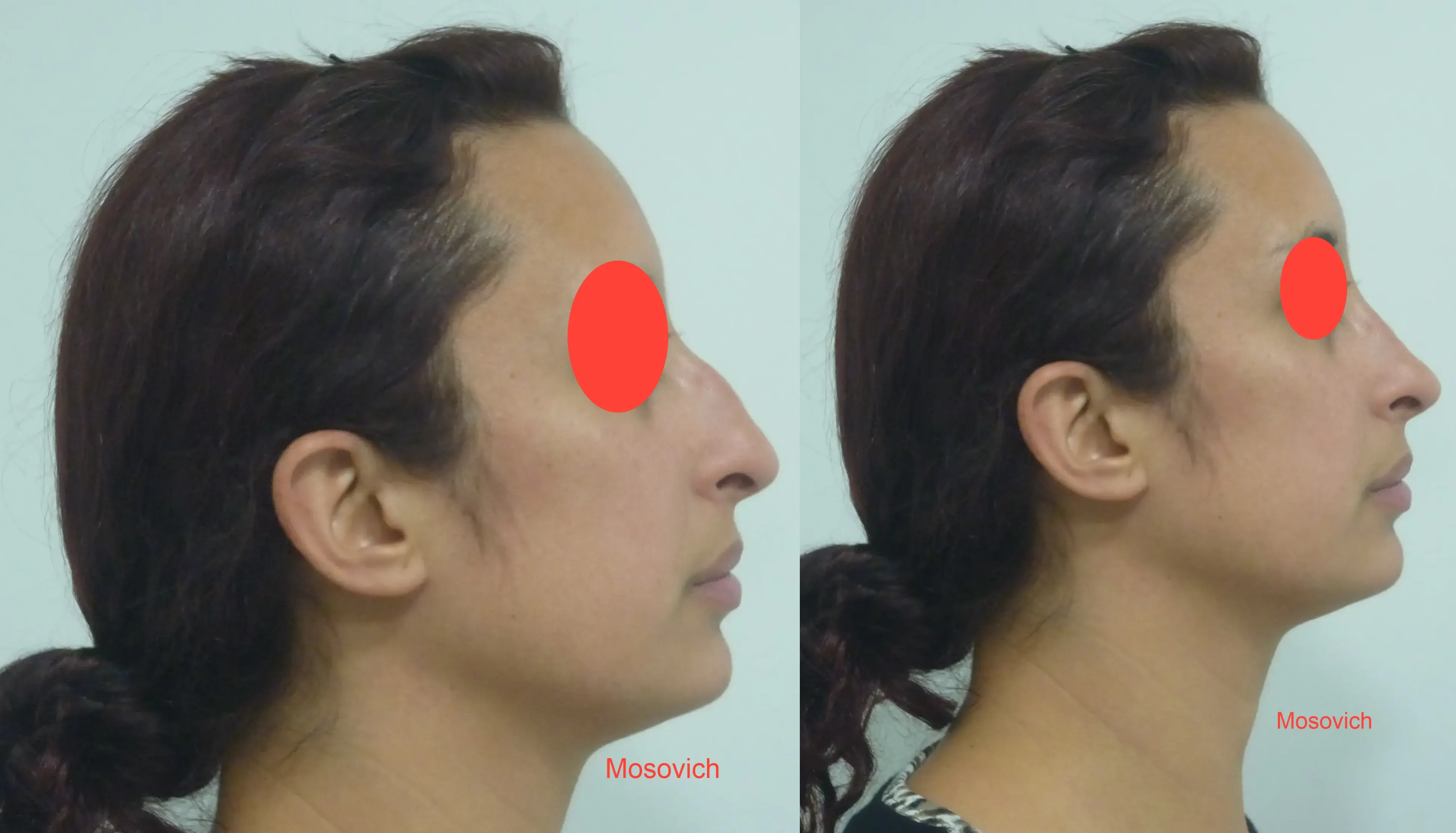 imagen rinoplastia