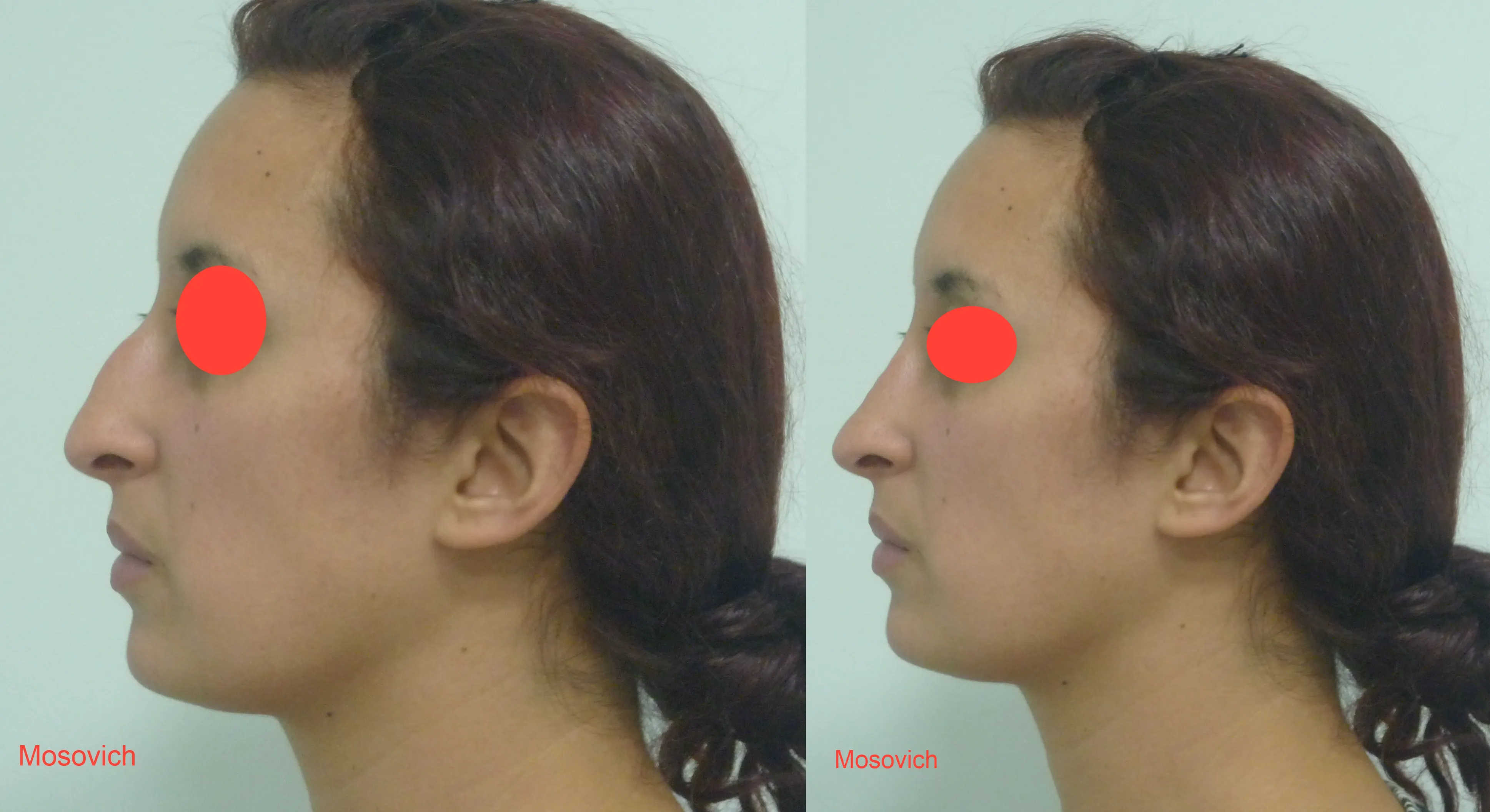 imagen rinoplastia