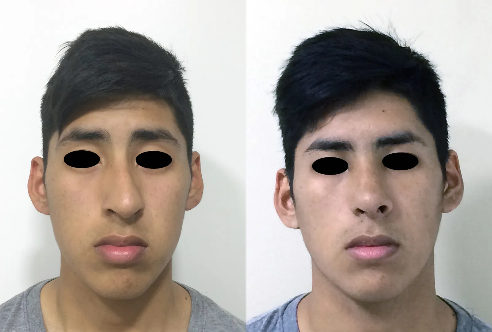 imagen rinoplastia foto antes después