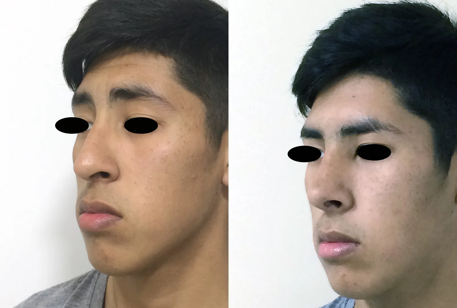 imagen rinoplastia foto antes después