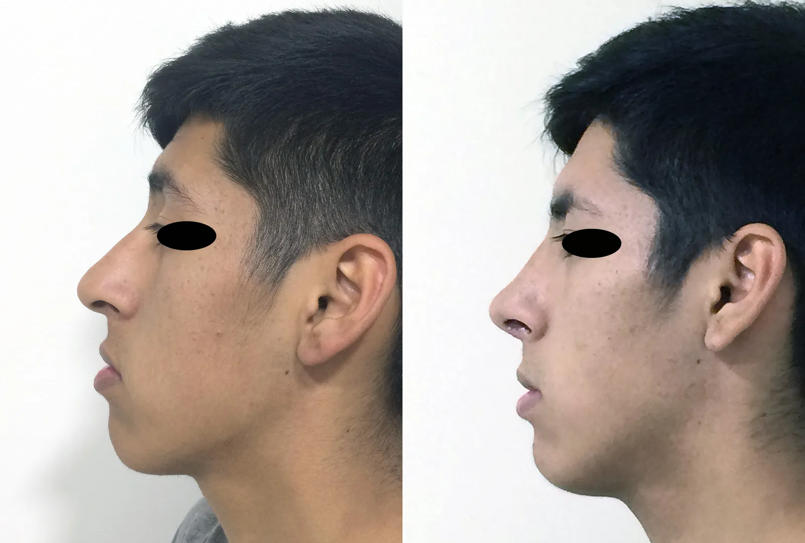 imagen rinoplastia foto antes después