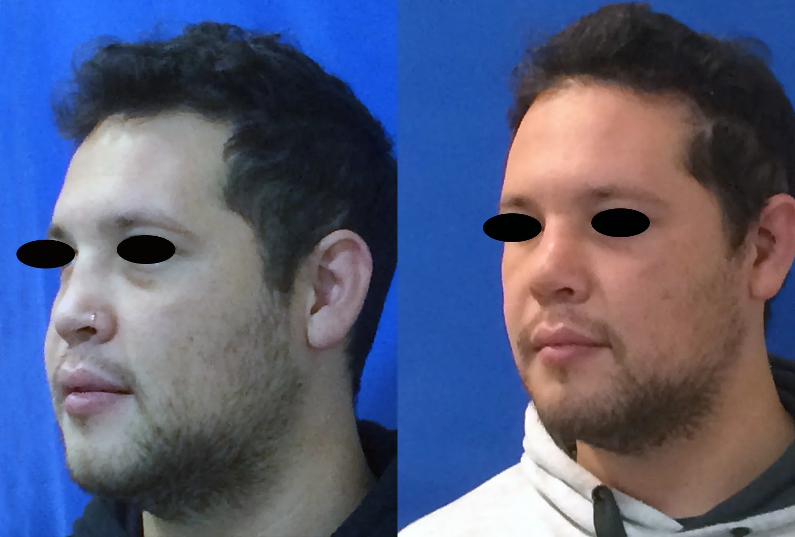 imagen rinoplastia foto antes después oblic caso 1