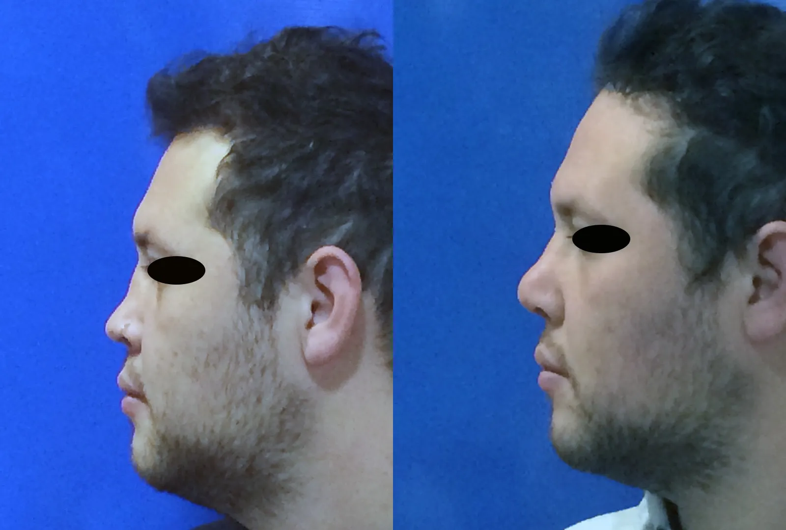 imagen rinoplastia foto antes después oblic aso 1