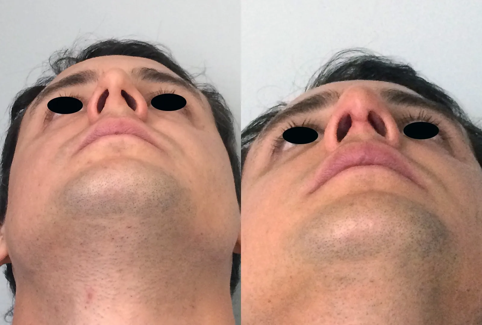 imagen rinoplastia foto antes después