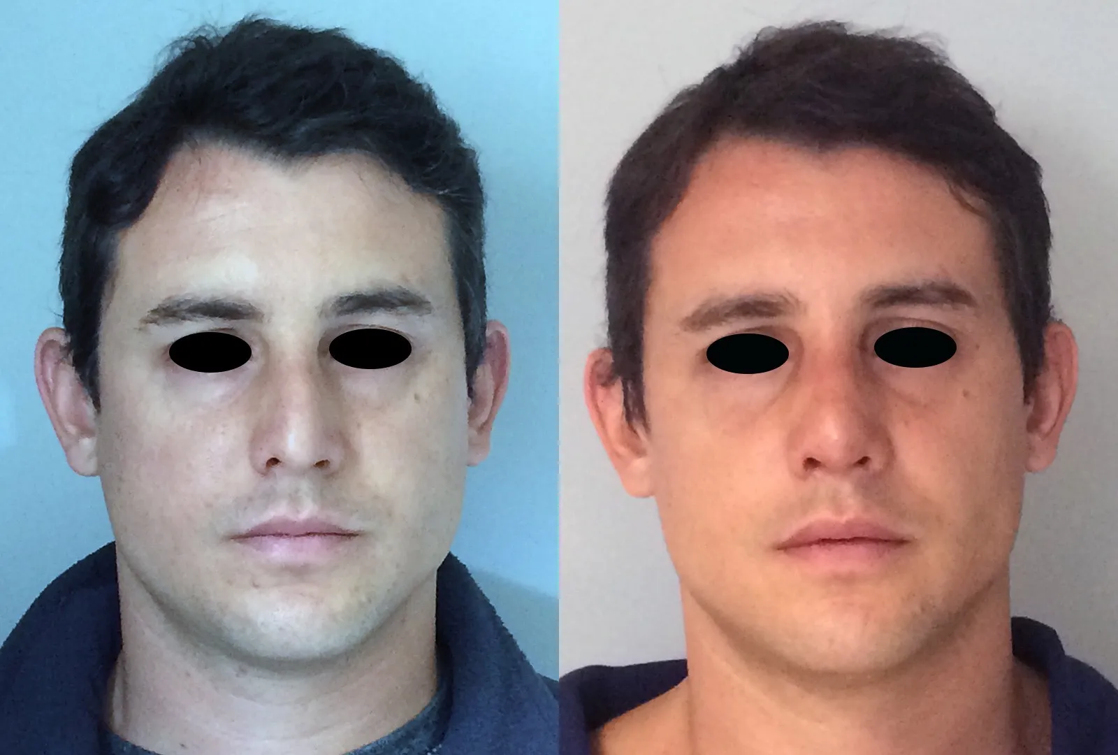 imagen rinoplastia foto antes después