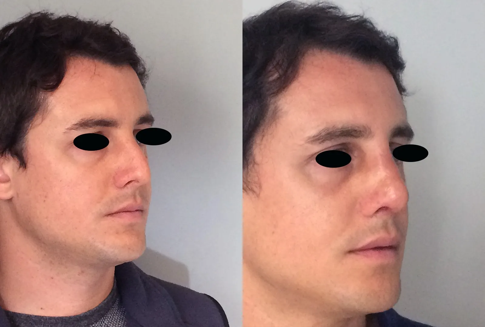 imagen rinoplastia foto antes después