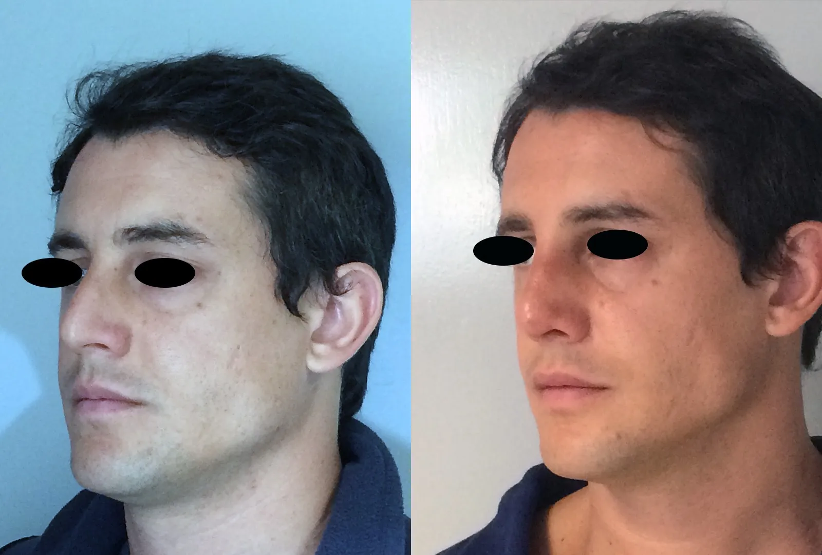 imagen rinoplastia foto antes después