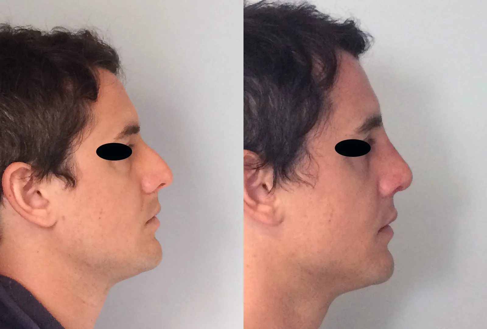 imagen rinoplastia foto antes después