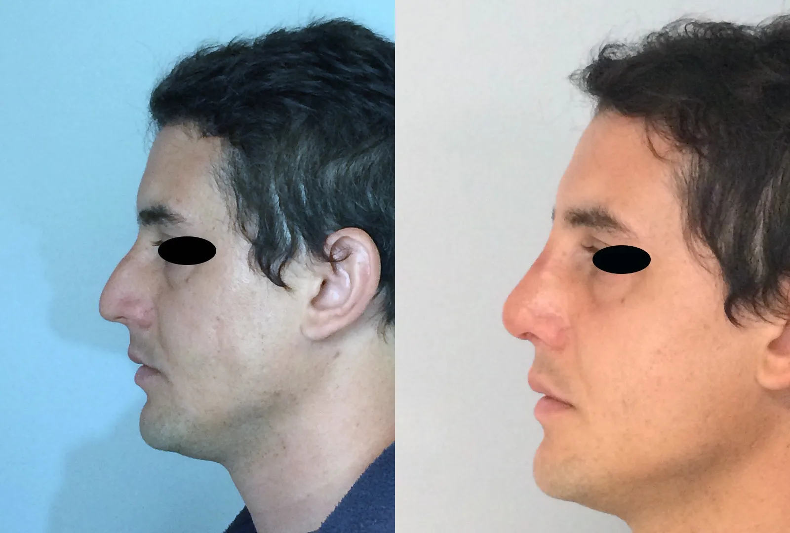 imagen rinoplastia foto antes después