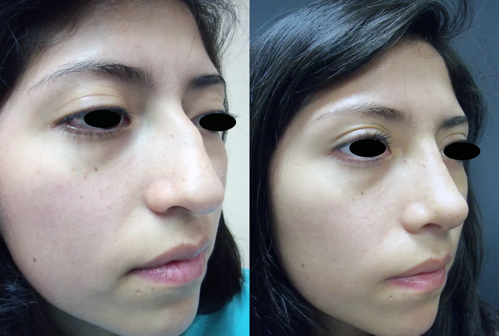 imagen rinoplastia foto antes después