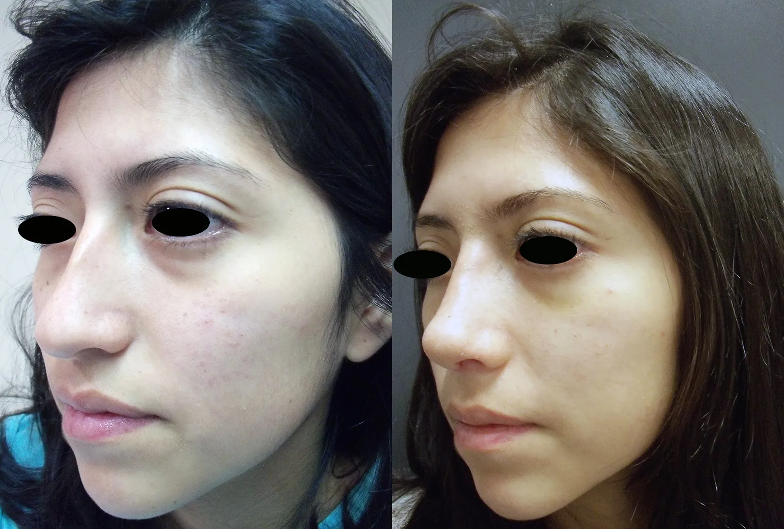 imagen rinoplastia foto antes después