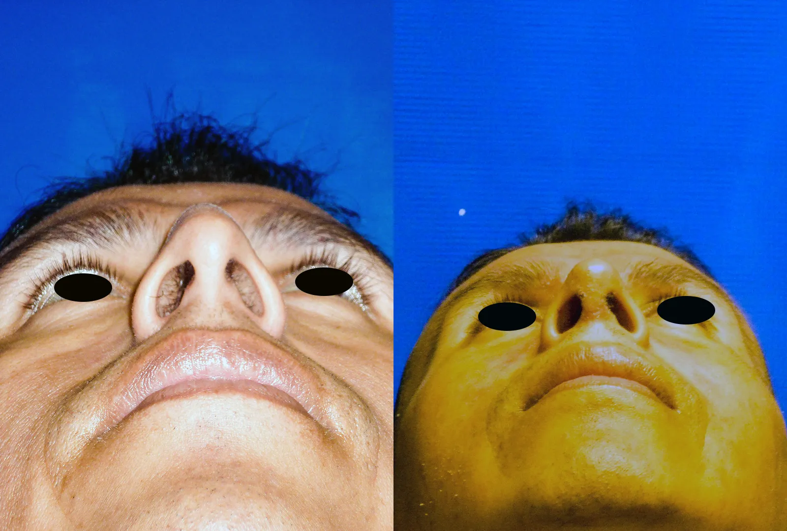 imagen rinoplastia foto antes después