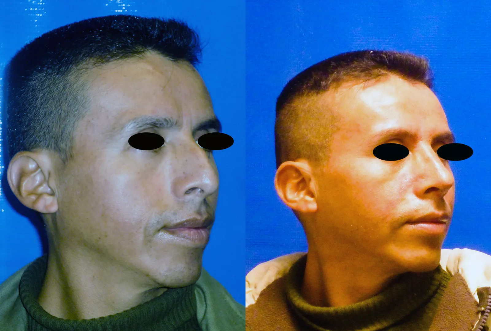 imagen rinoplastia foto antes después