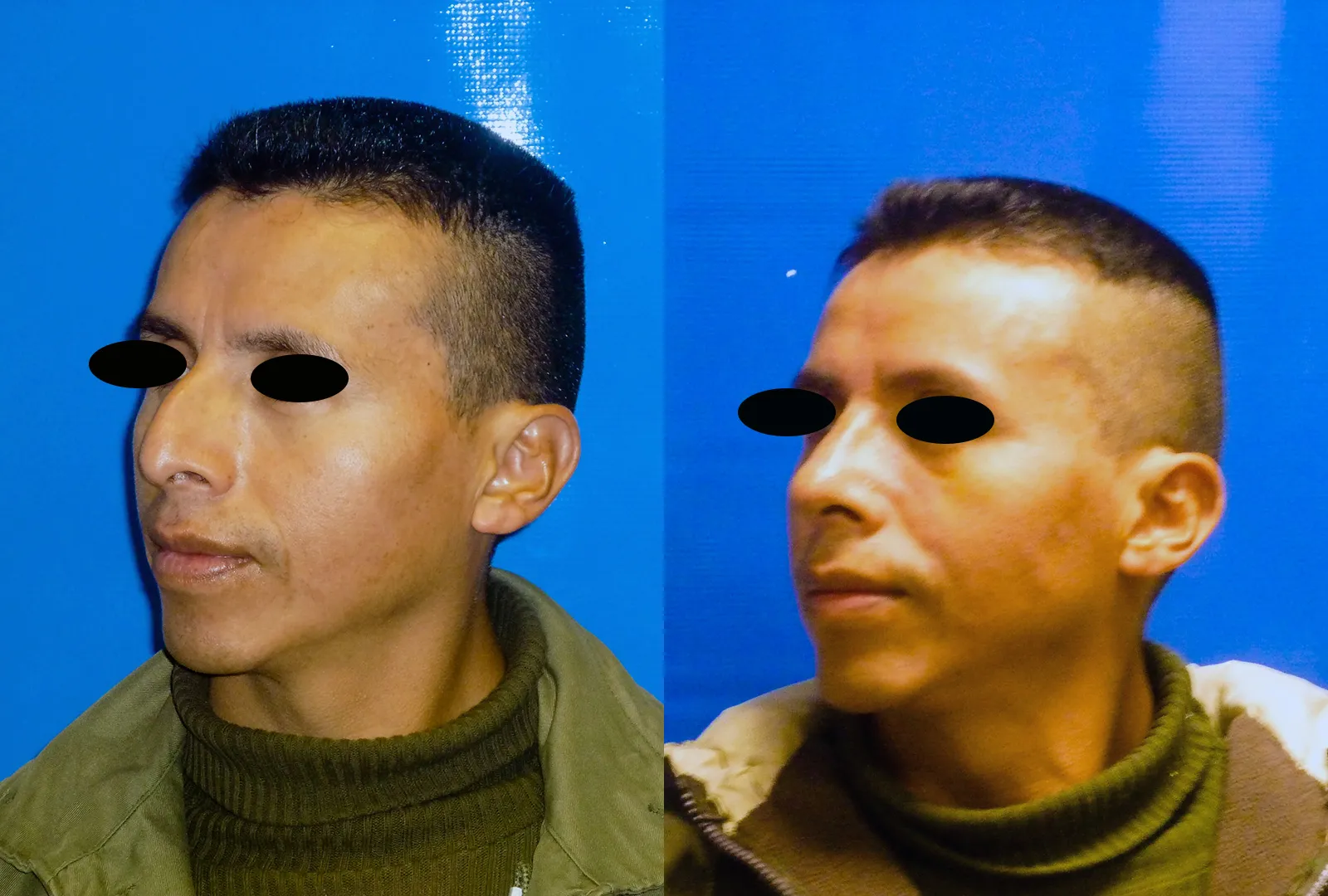 imagen rinoplastia foto antes después