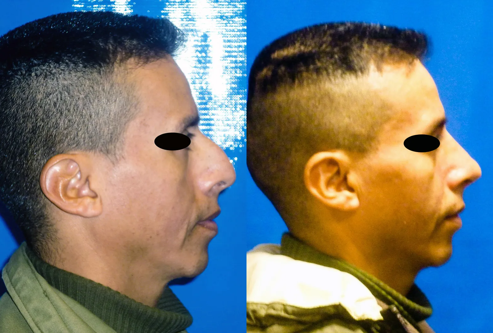 imagen rinoplastia foto antes después