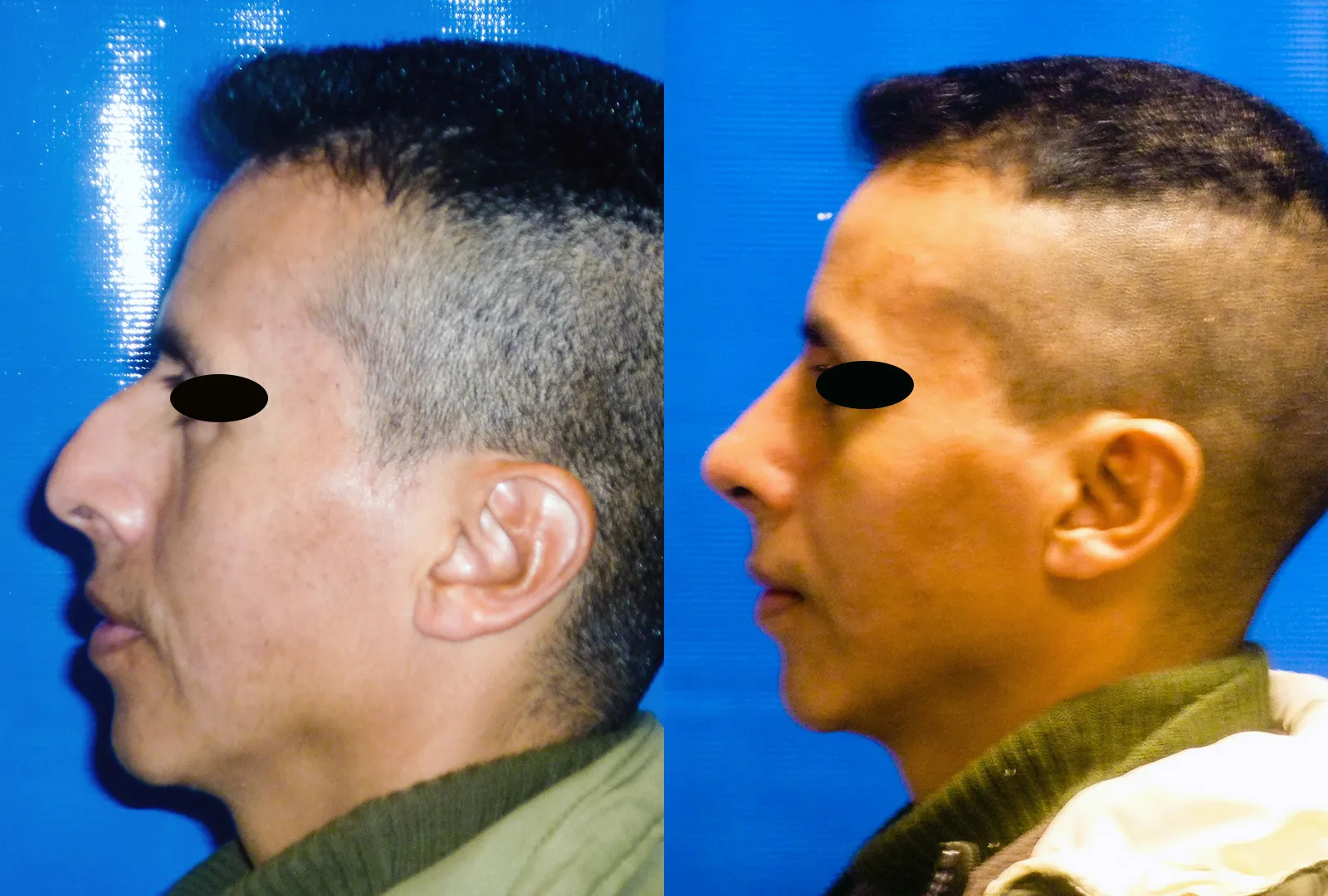 imagen rinoplastia foto antes después