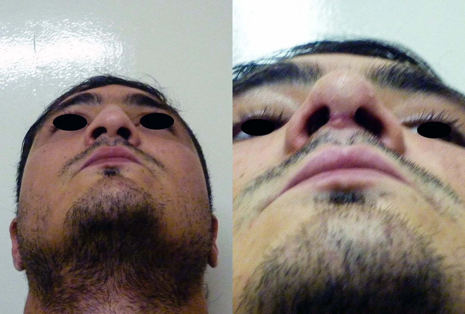 imagen rinoplastia foto antes después