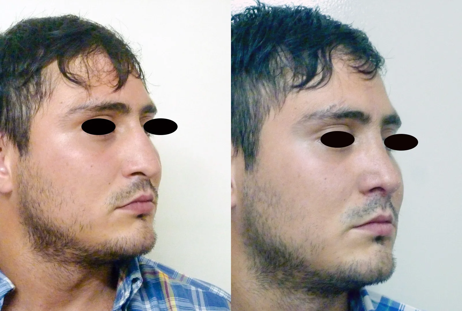 imagen rinoplastia foto antes después