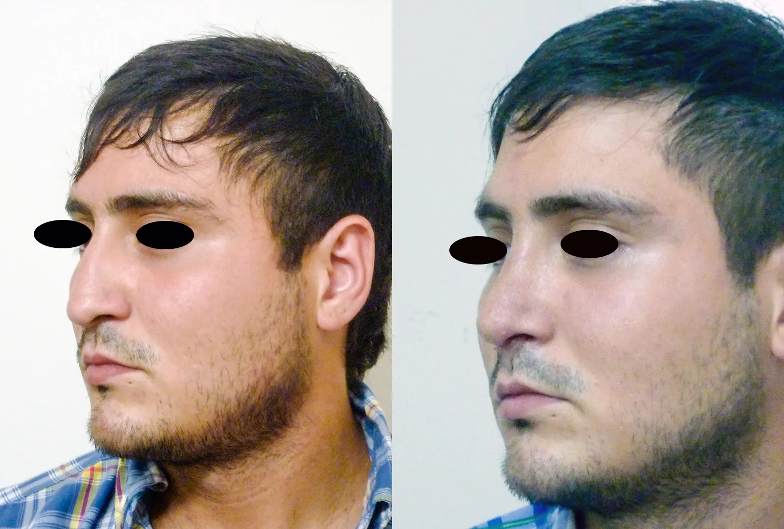 imagen rinoplastia foto antes después