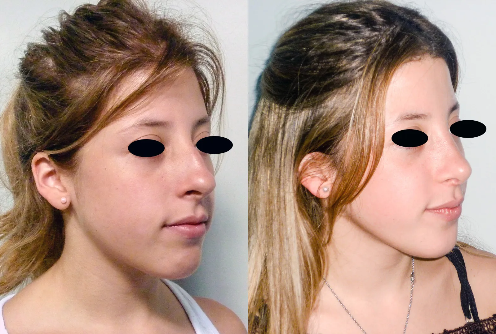 imagen rinoplastia foto antes después