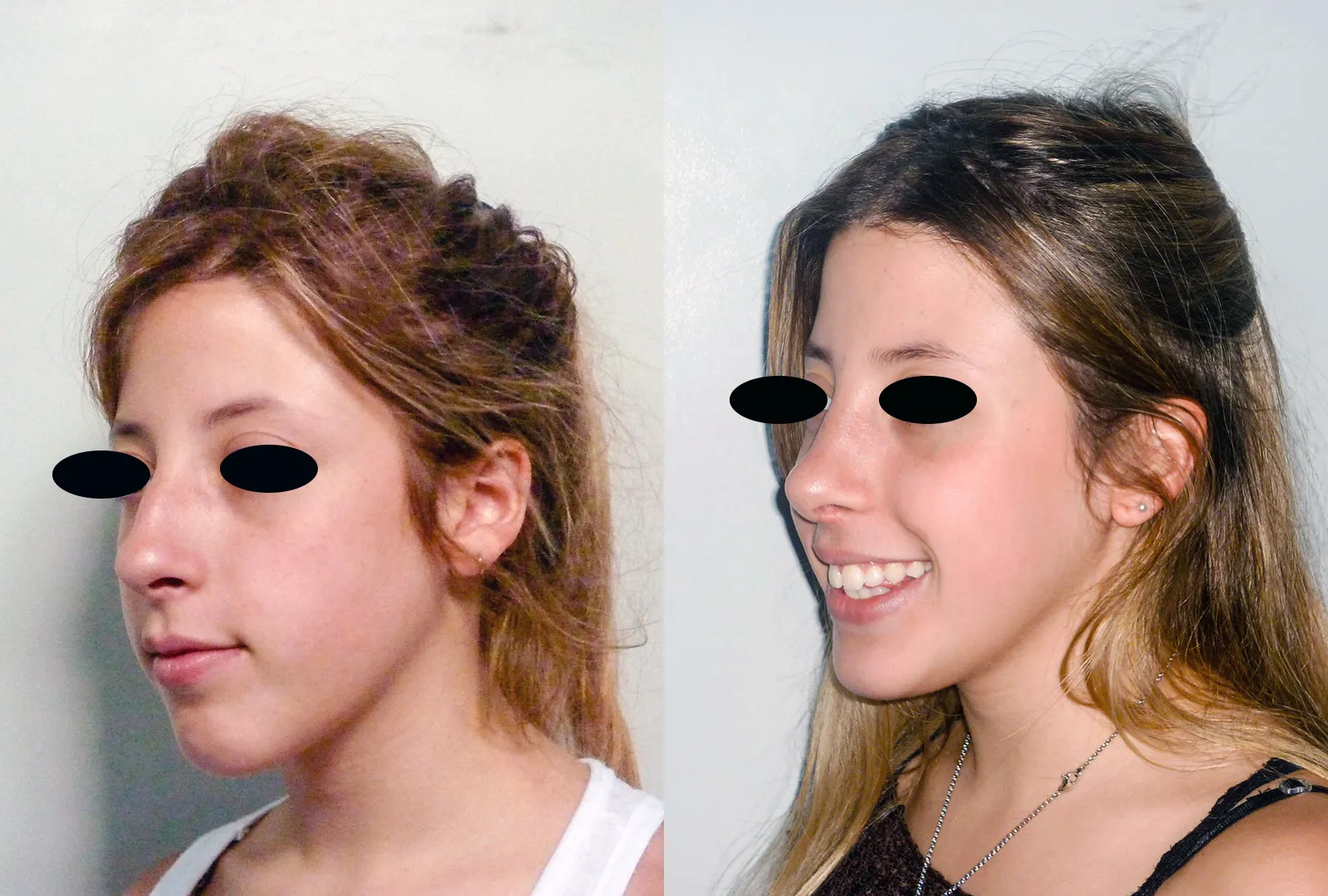 imagen rinoplastia foto antes después