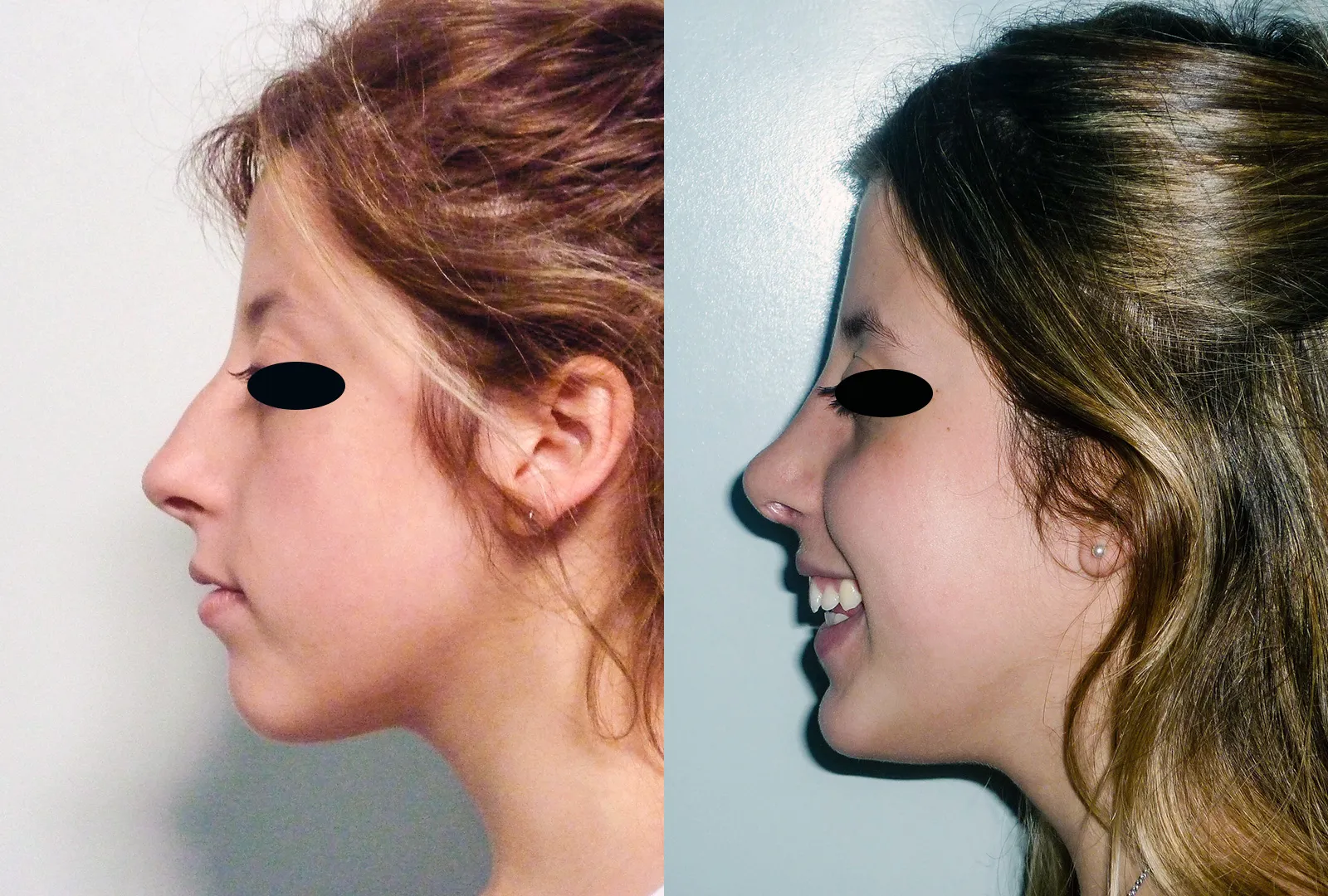 imagen rinoplastia foto antes después