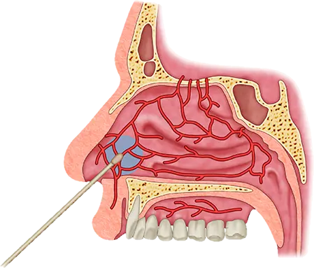 imagen de cauterización de arterias nasales por epistaxis