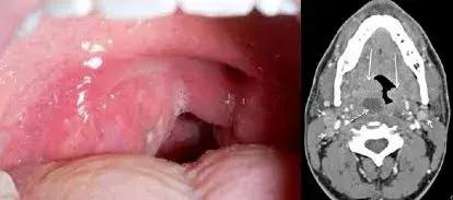 TAC e imagen de absceso amigdalino