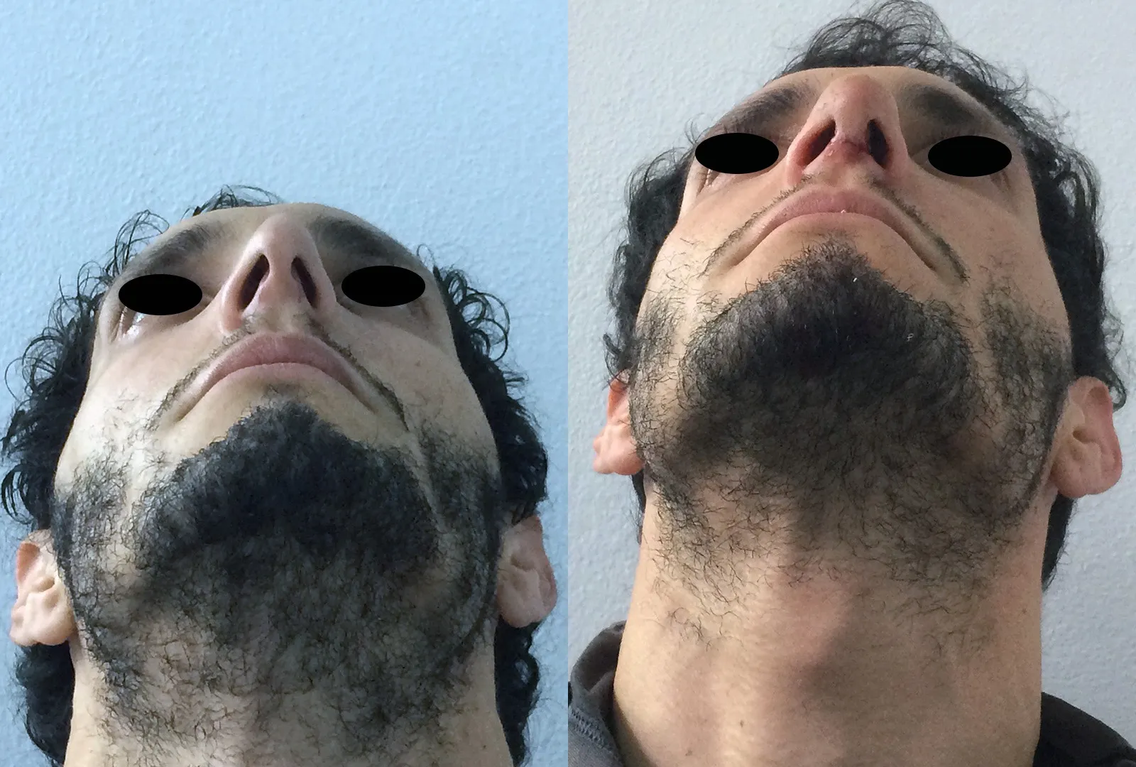 imagen rinoplastia foto antes después