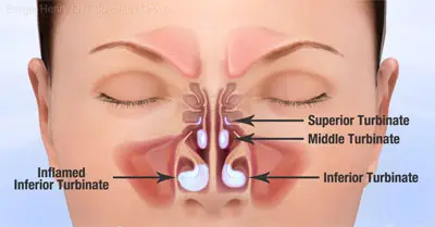 imagen de cornetes nasales