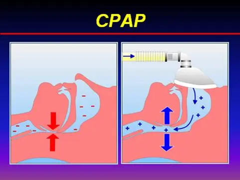 cpap antes y despues imagen