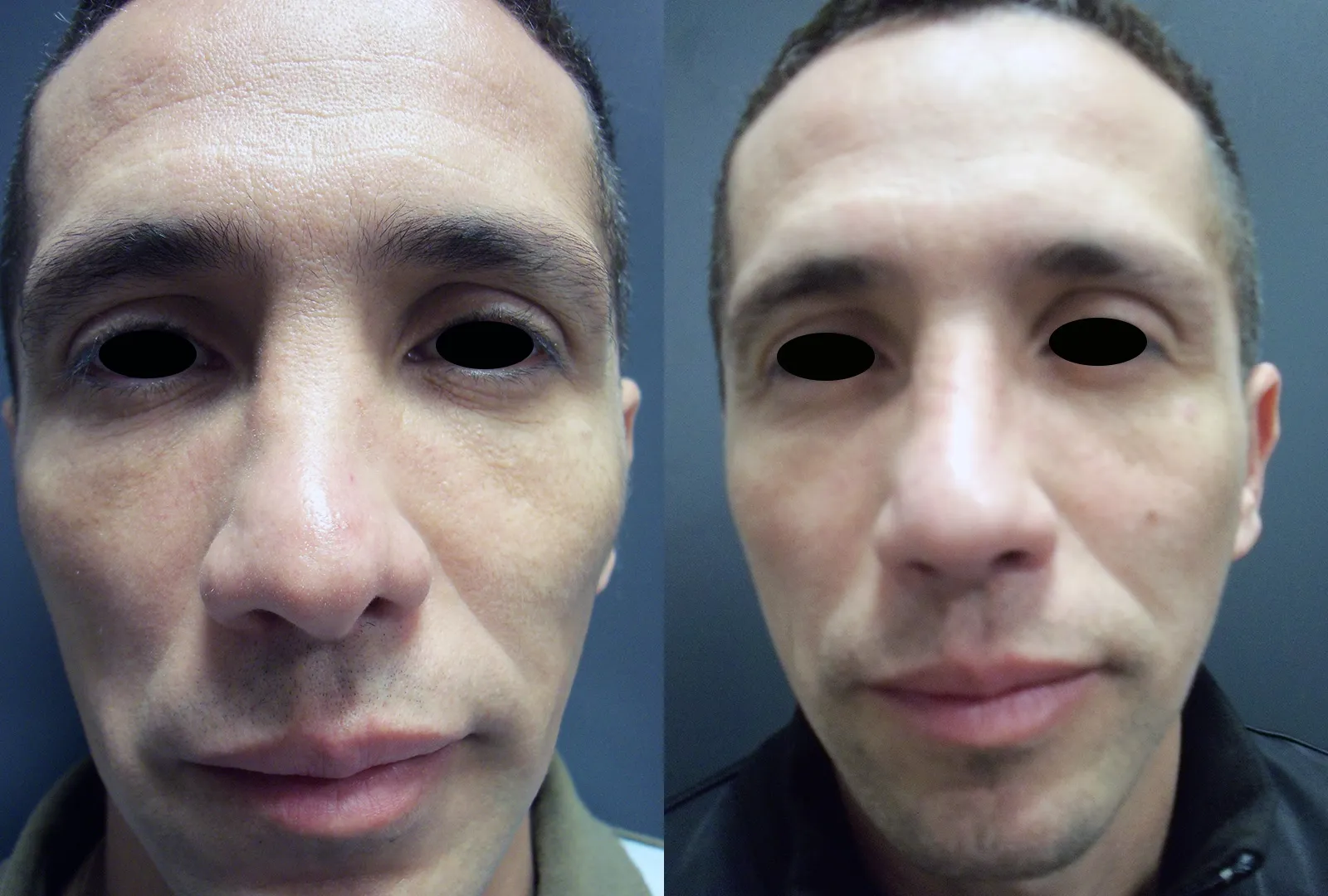 imagen rinoplastia foto antes después