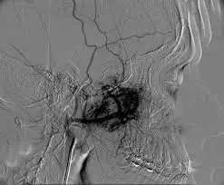 imagen de cauterización de arterias nasales por epistaxis