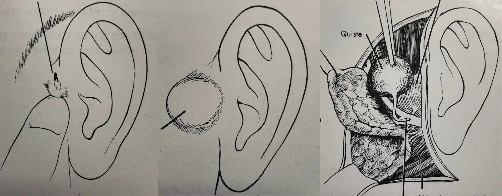 ejemplos de fositas y quistes preauriculares