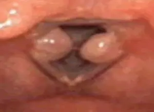 granulomas en laringe