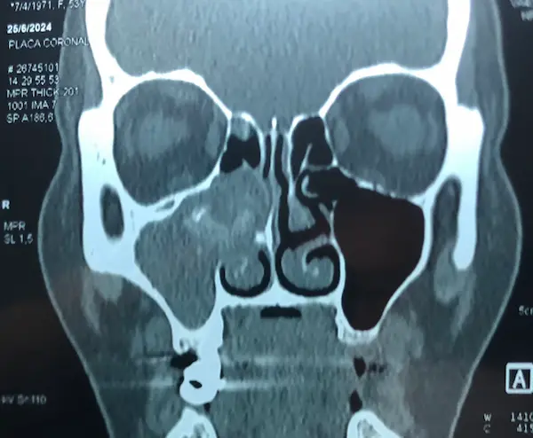 tomografia de sinusitis por hongos