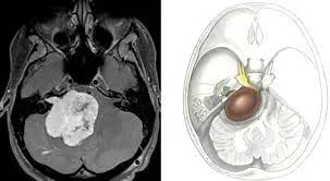 imagen de un neurinoma del acústico