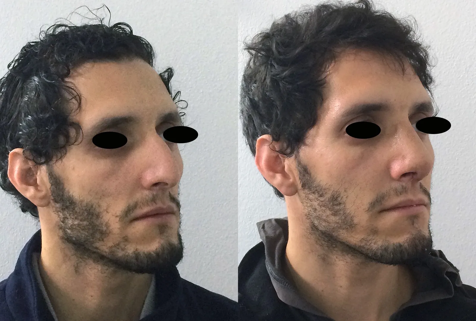 imagen rinoplastia foto antes después