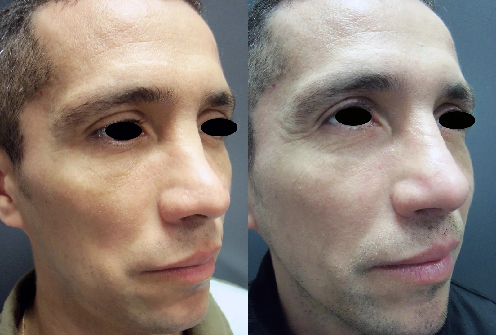 imagen rinoplastia foto antes después