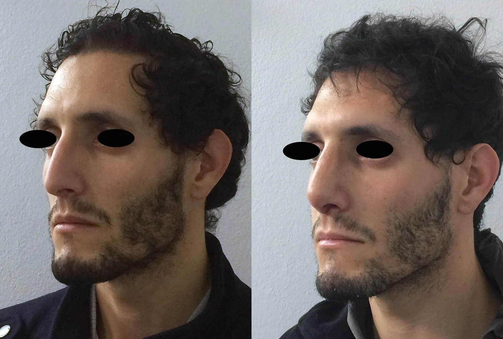 imagen rinoplastia foto antes después