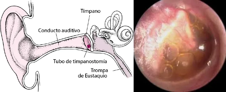 imagen de otopatia serosa