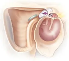 otitis colesteatomatosa infografia.