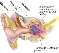 infografía de otitis media