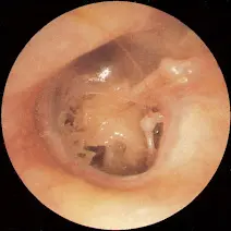 imagen de otitis cronica