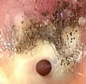 otomicosis imagen de otoscopia