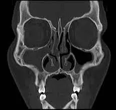 signos de sinusitis en tomografia